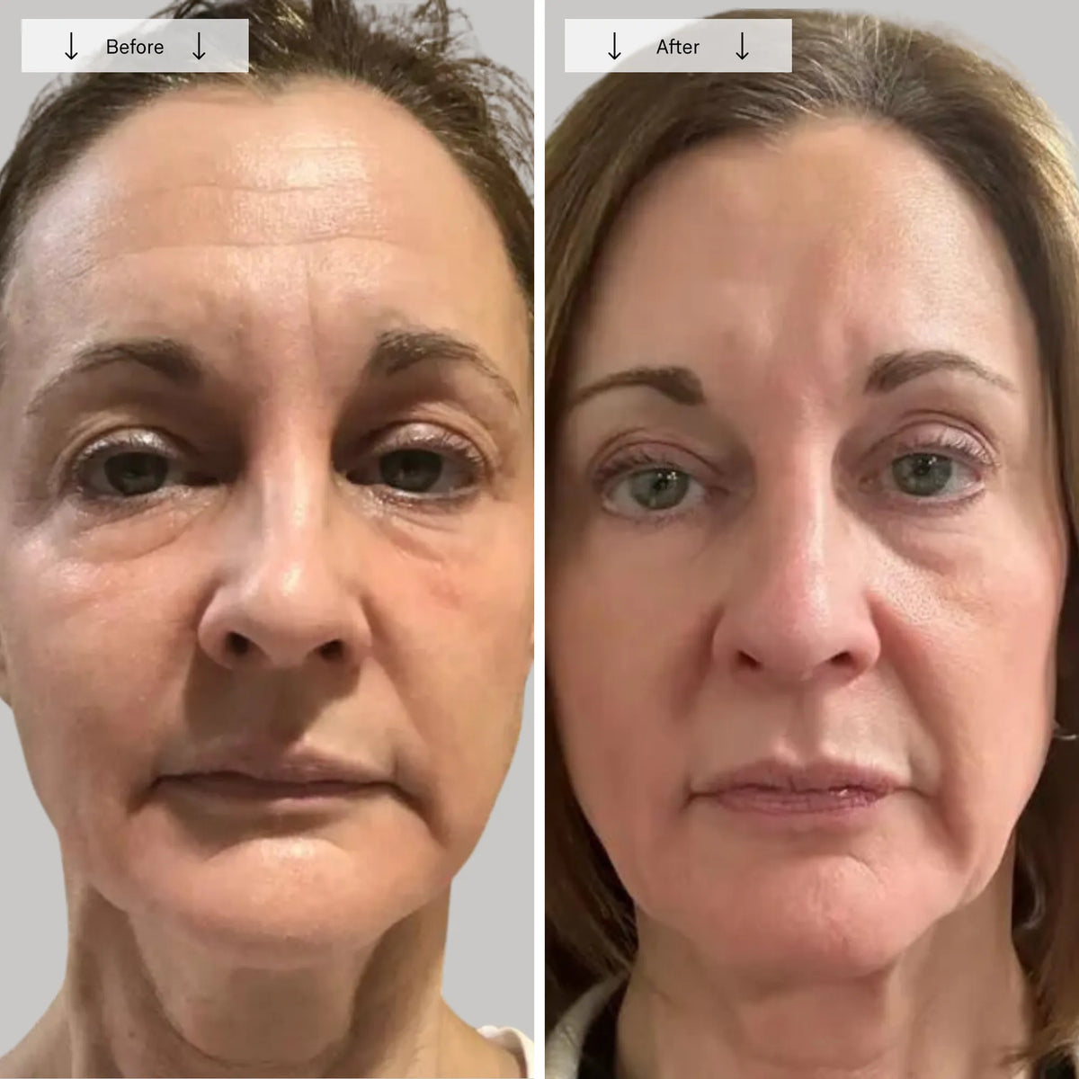 Contour LED Light Therapy Face Mask