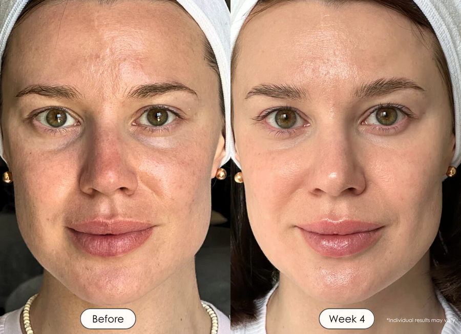 Fine Lines, Sun Damage