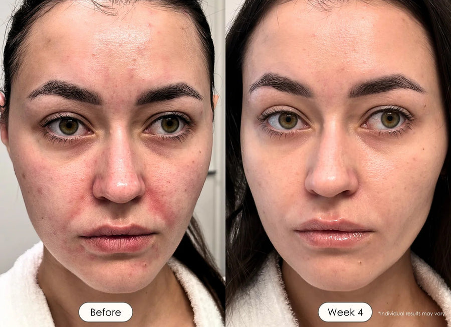 Inflammation, Redness