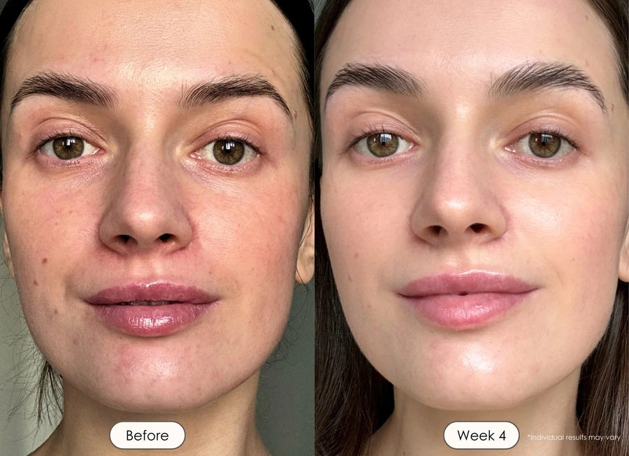 Uneven Skin tone, Hyperpigmentation